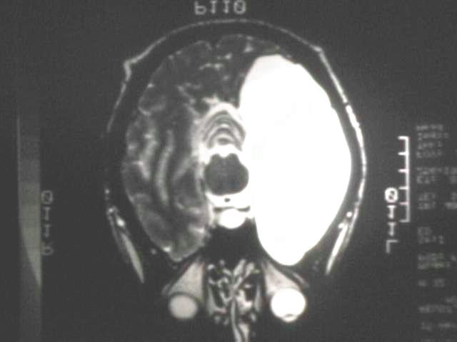 Arachnoid Cyst